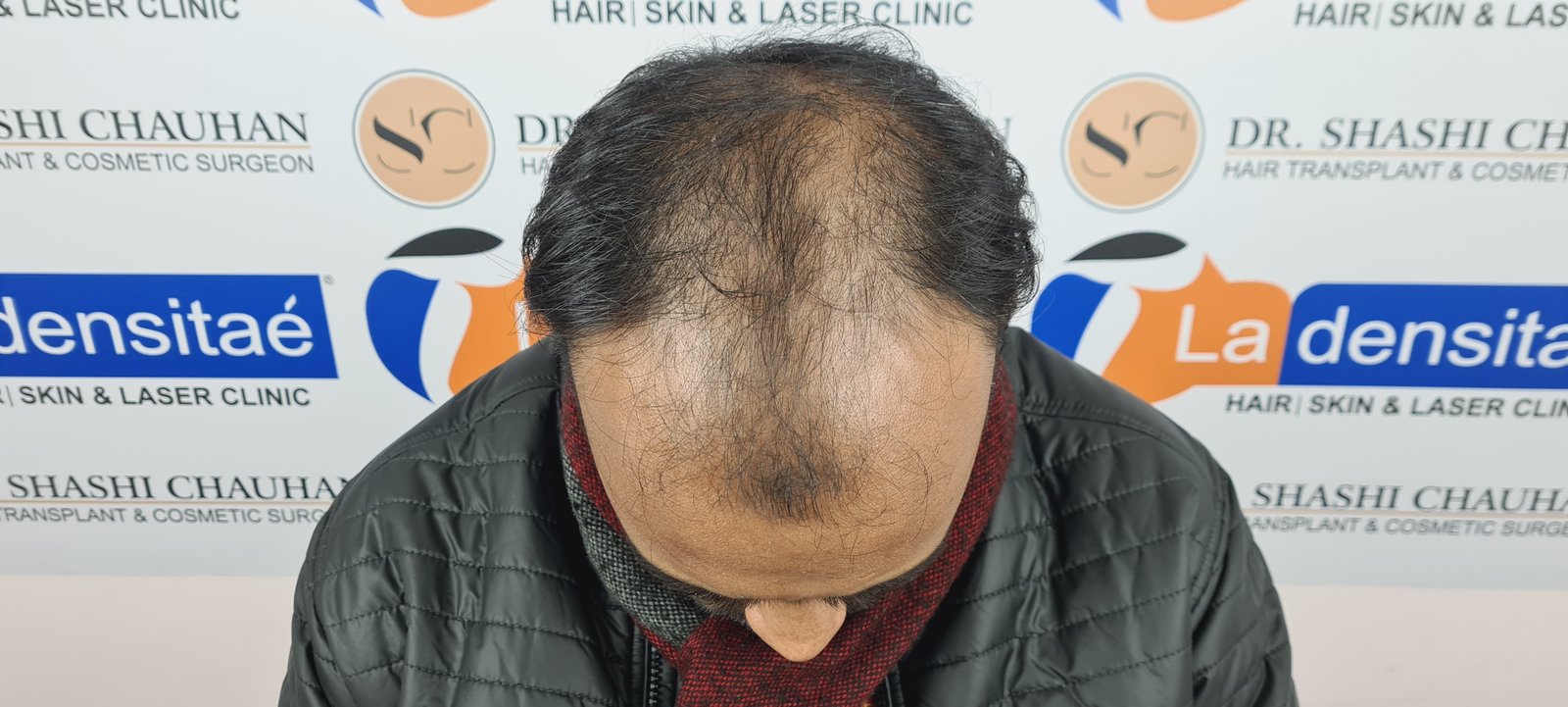 Abhay Pratap Yadav Before Hair Transplant